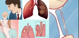 dấu hiệu nhận biết ung thư phổi