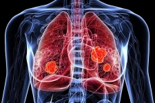 Phát hiện sớm ung thư phổi bằng cách nào?