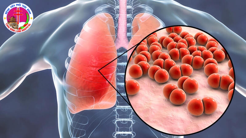 Nguyên nhân gây bệnh phổi kẽ và cách điều trị hiệu quả