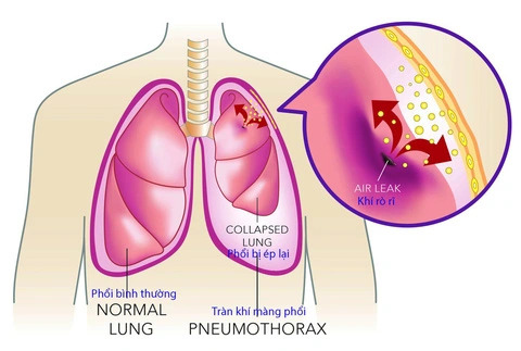 tràn khí màng phổi